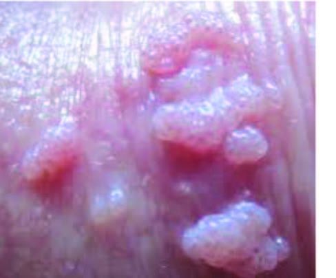 papilloma virus verruche lingua)